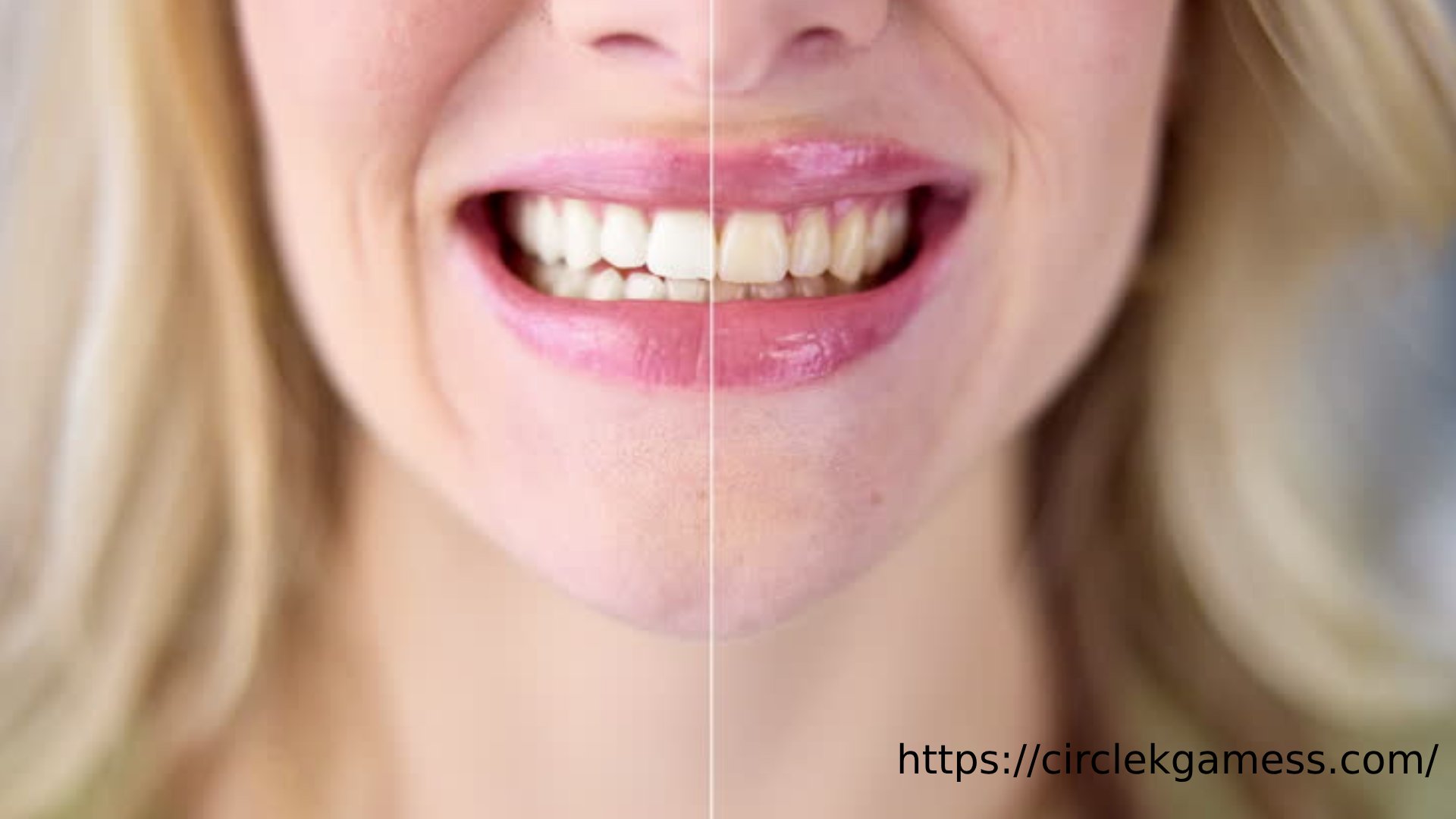 Veneers Before and After